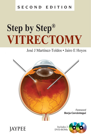 Step by Step Vitrectomy