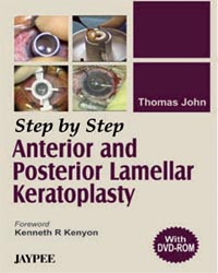 Step by Step Anterior and Posterior Lamellar Keratoplasty (with DVD-ROM)