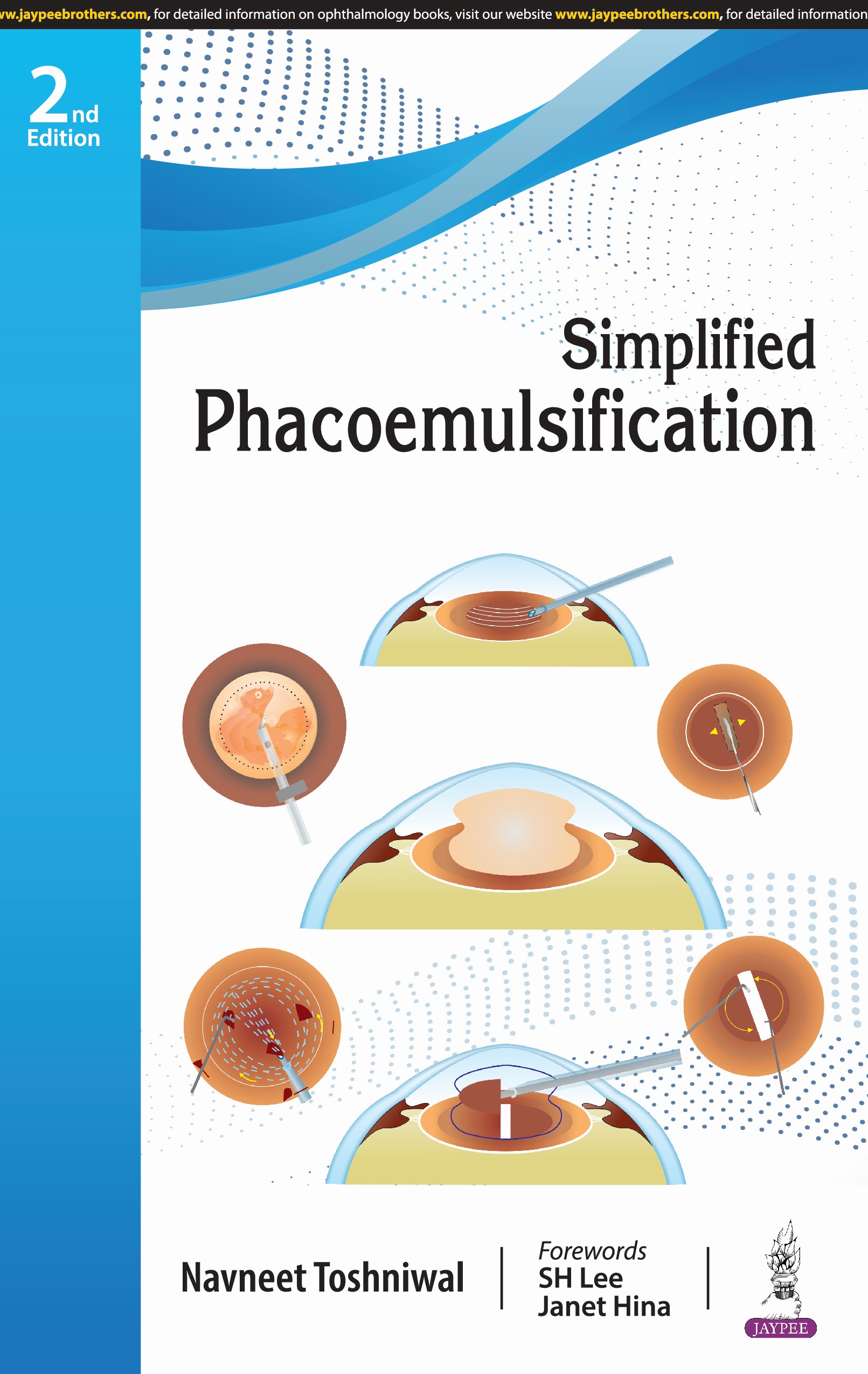 Simplified Phacoemulsification