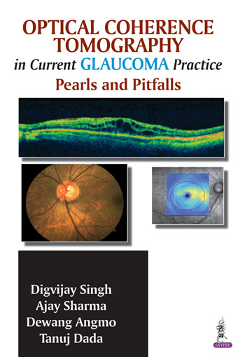 Optical Coherence Tomography in Current Glaucoma Practice: Pearls and Pitfalls