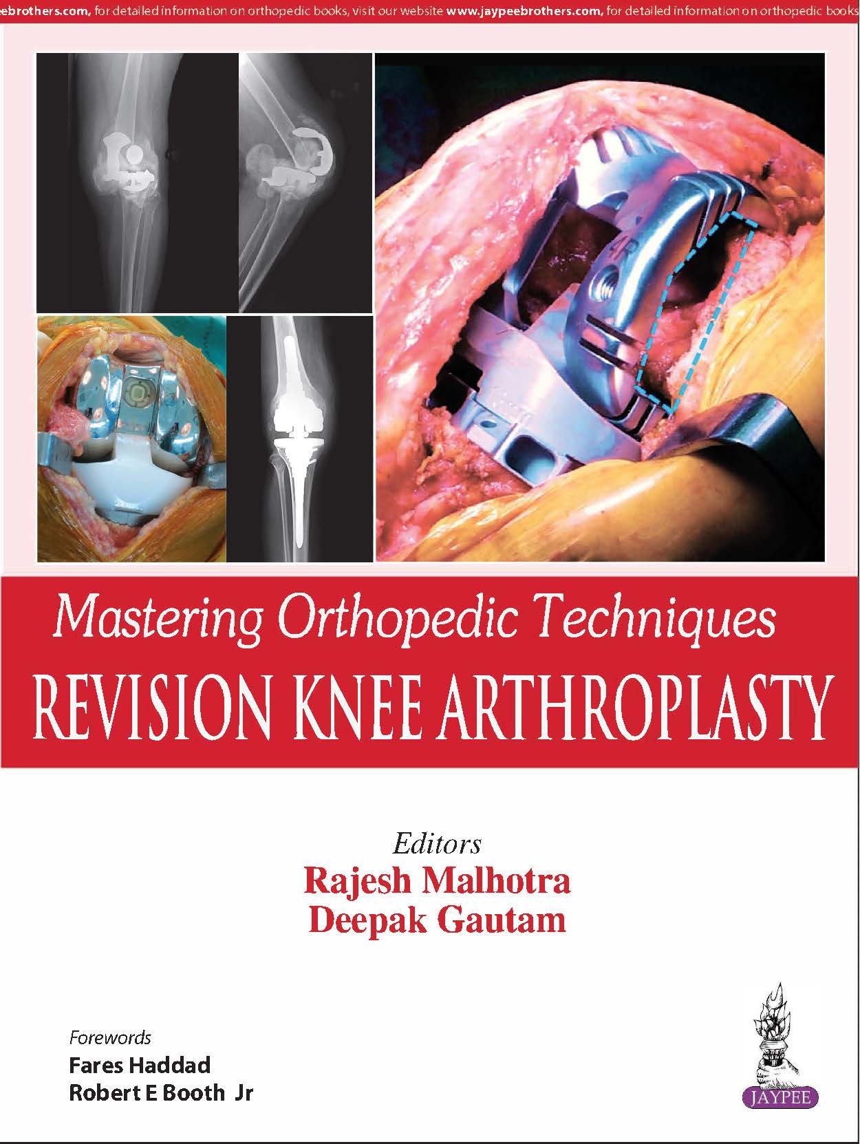 Mastering Orthopedic Techniques:Revision Knee Arthroplasty