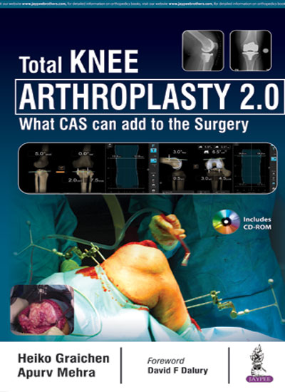 Total Knee Arthroplasty 2.0 What CAS can add to the Surgery (Includes CD-ROM)