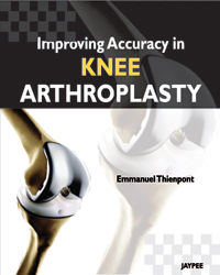 Improving Accuracy in Knee Arthoplasty