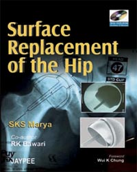 Surface Replacement of The Hip with DVD-ROM