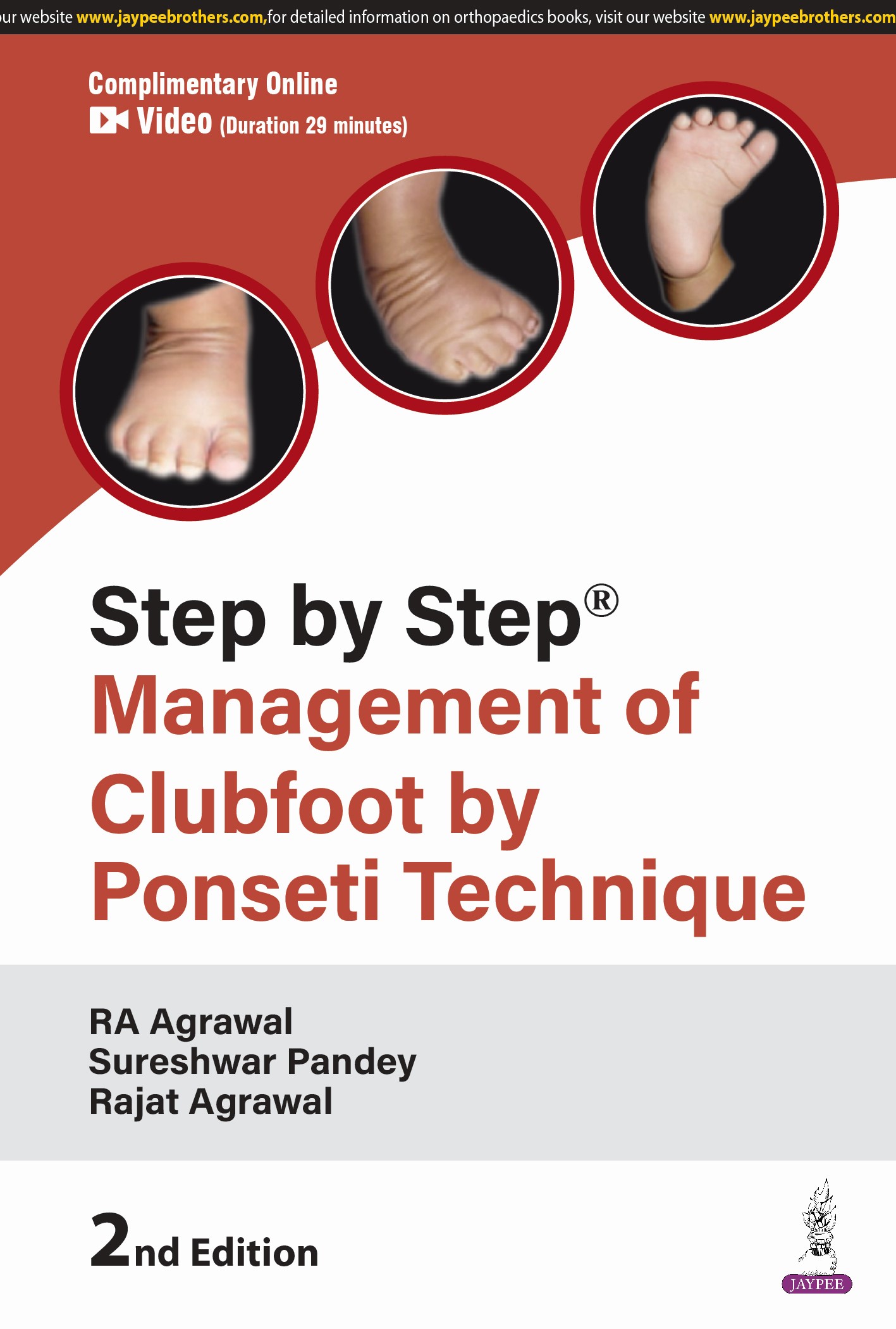 Step by Step Management of Clubfoot by Ponseti Technique