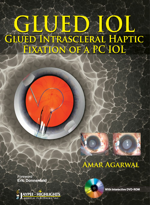  Glued IOL: Glued Intrascleral Haptic Fixation of a PC IOL