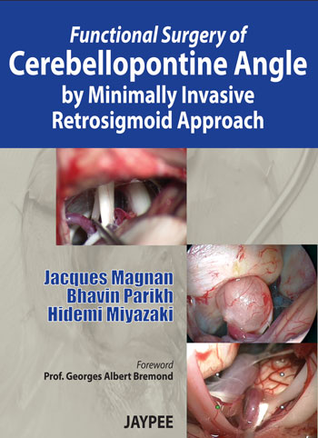  Functional Surgery of Cerebellopontine Angle by Minimally Invasive Retrosigmoid Approach