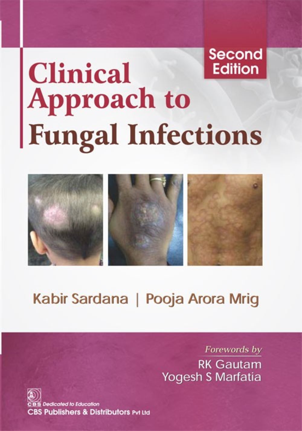 Clinical Approach to Fungal Infections