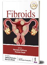 Fibroids